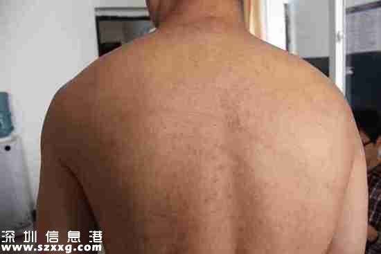 2013年4月22日，王志刚被转送到剑阁县看守所，重新检查了身体状况。照片显示，王志刚的后背有条状色素沉着。